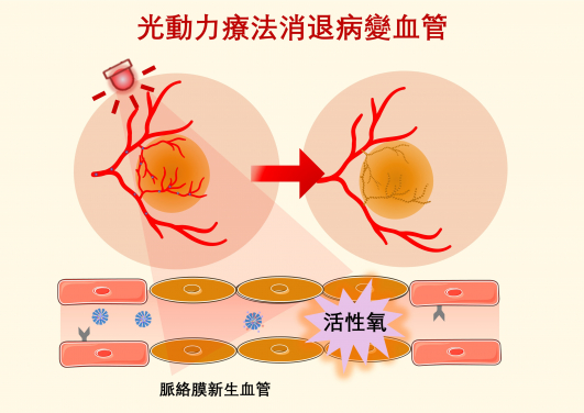 光動力療法提供一種臨床解決方案，利用特定波長的光照激活無毒光敏藥物，產生活性氧，從而破壞和清除病變血管。
 